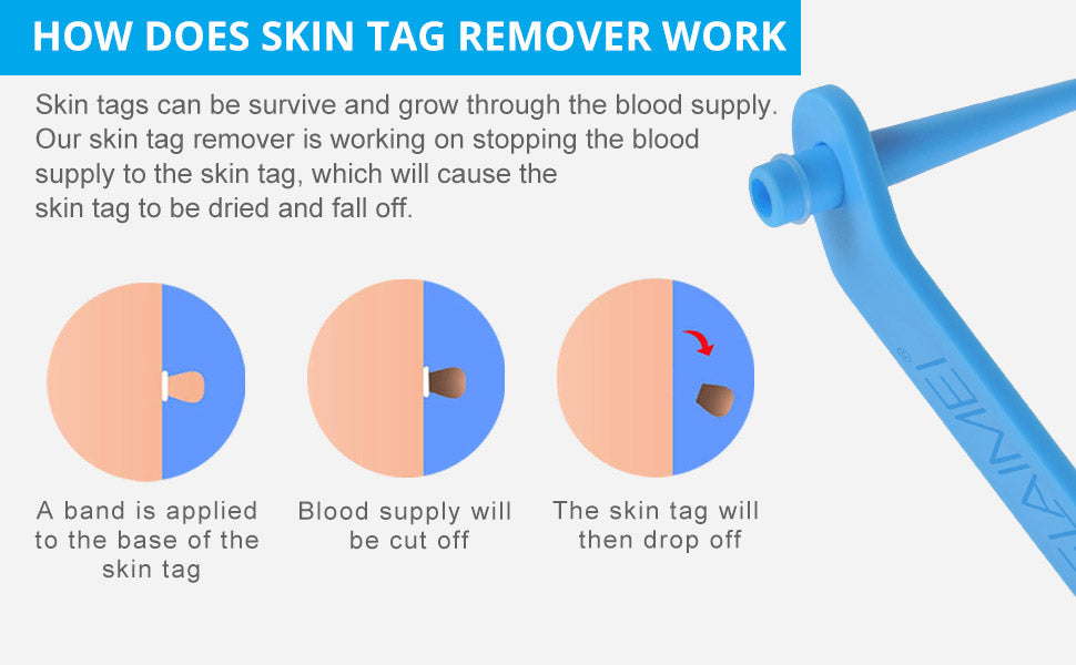 Skin Tag & Mole Remover Kit, Fast And Easy Removal For Size 2mm-8mm, Safe And Painless, Smooth Results in Minutes For Face & Body, With 40 Removal Bands, 10 Cleansing Wipes, 36 Skin Tag Repair Patches