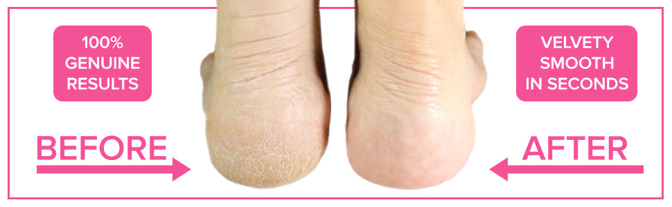 ULTIMATE Pedicure Foot File Foot Scraper Hard Skin Remover Foot Files For Hard Skin (Large) MEGAFILE Pumice Stone For Feet Hard Skin Remover Foot Scraper - Callus Remover For Feet Rasp Egg Ped Pedi