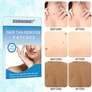 Skin Tag Removal Patches,Skin Tag Removal,Mole Remover,Skin Tag Patches,Mole Removal Patches,Acne Pimple Healing Patches,Skin Tag Treatment Patches,Effective To Remove Moles And Skin Tags,108PCS